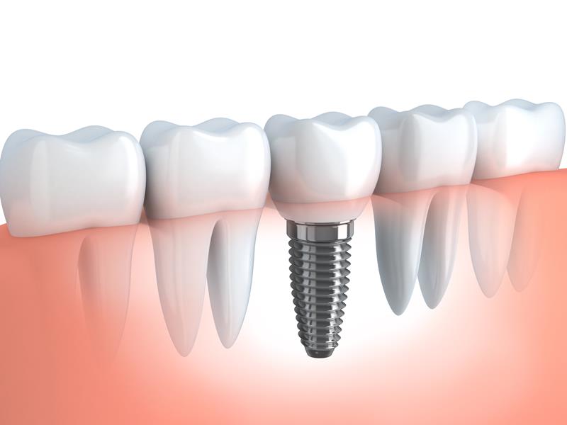 Dental Implants El Cajon, CA