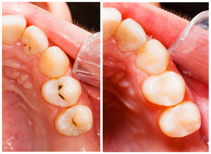 Fillings  El Cajon, CA 